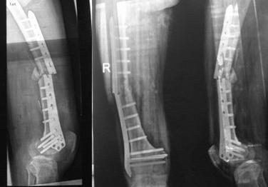 检测腿部骨骼软件