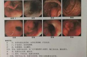 The man is abdominal distension be afraid of do gastroscope, by fish cancer of the stomach