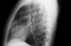 The heart is like pinprick: Fine number those curi