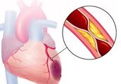 Acute cardiac muscle straightens dead, can monobel eat casually? Listen to a doctor how to say?