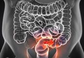 Cancer of bowel of 33 years old of groups of small