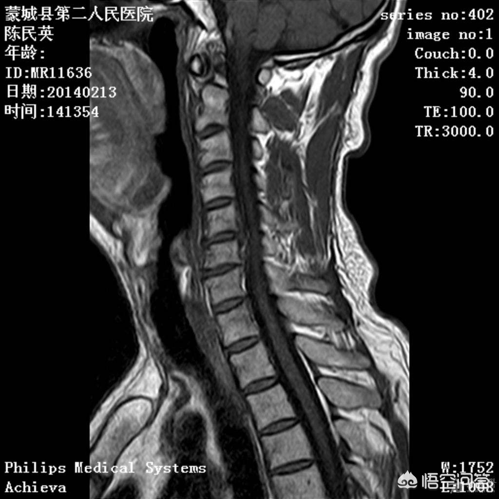 在医院检查拍的ct片、核磁共振片带回家后，有保存的必要吗？ 头条问答