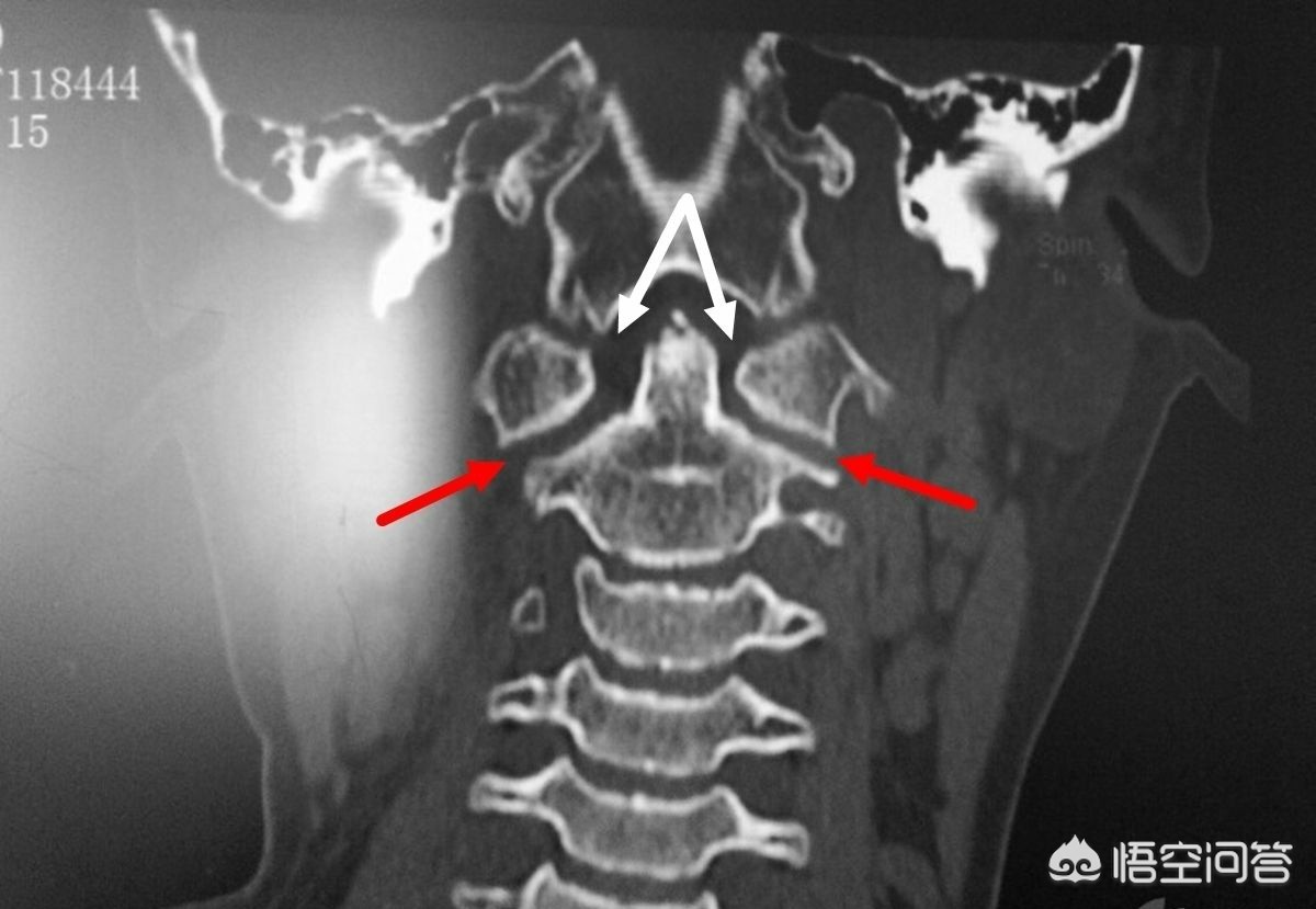 宠物DR拍摄诊断案例——寰枢椎半脱位 - 知乎