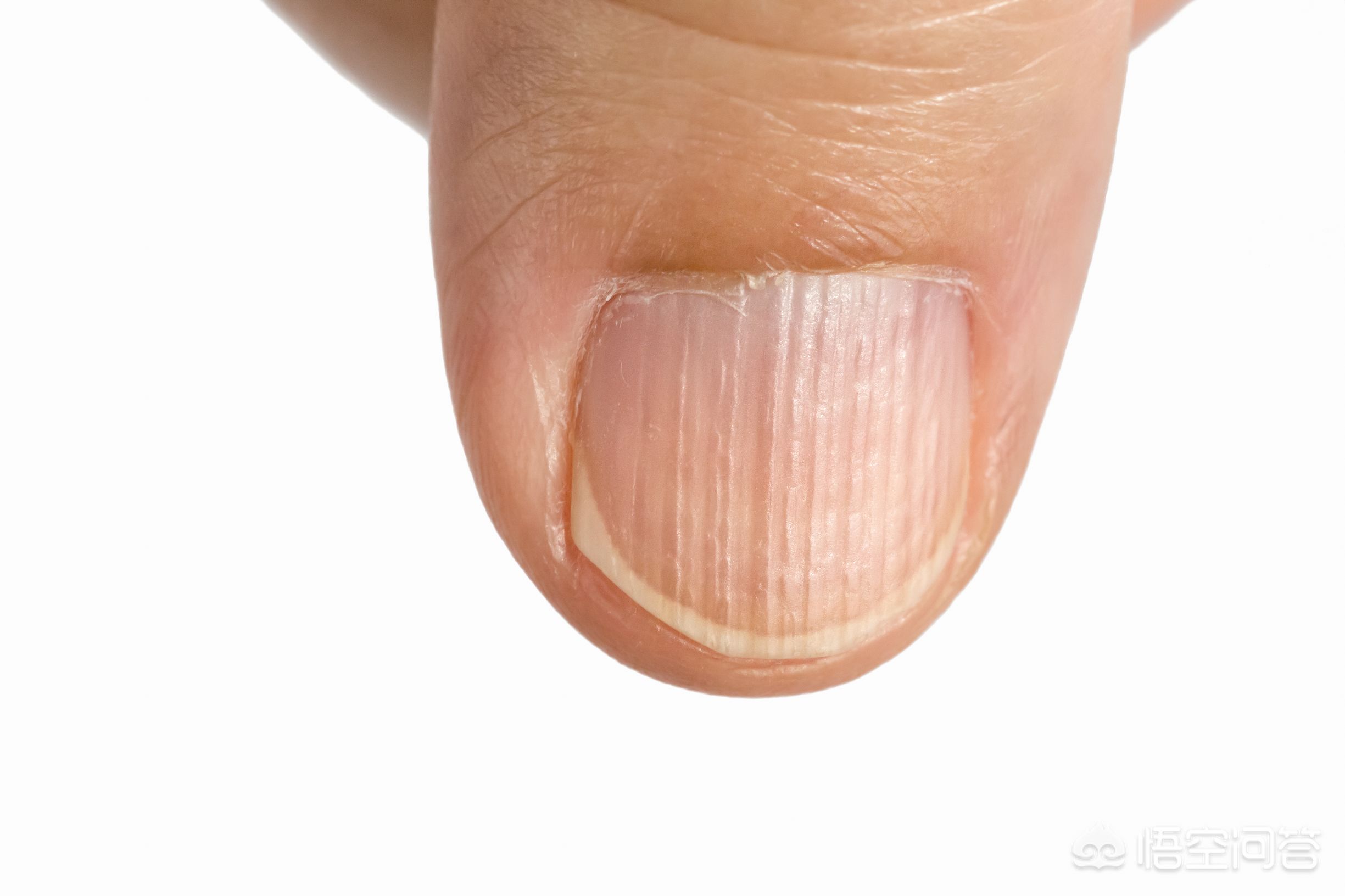 指甲长竖纹、白斑、黑线...是“疾病征兆”？这些实情，现在知道还不晚_蛋白质_维生素_白点