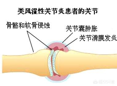 怎么判斷是不是類風濕（風濕的癥狀有哪些表現）