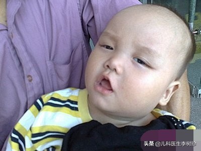 腦癱有什么癥狀表現（腦癱的常見癥狀）