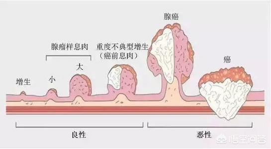 一招判断是不是直肠癌（早期肠癌最明显的一个征兆）