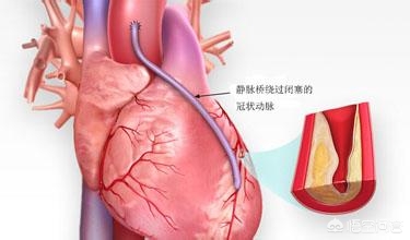 老年人进行心脏搭桥手术后感到腿疼怎么办?
