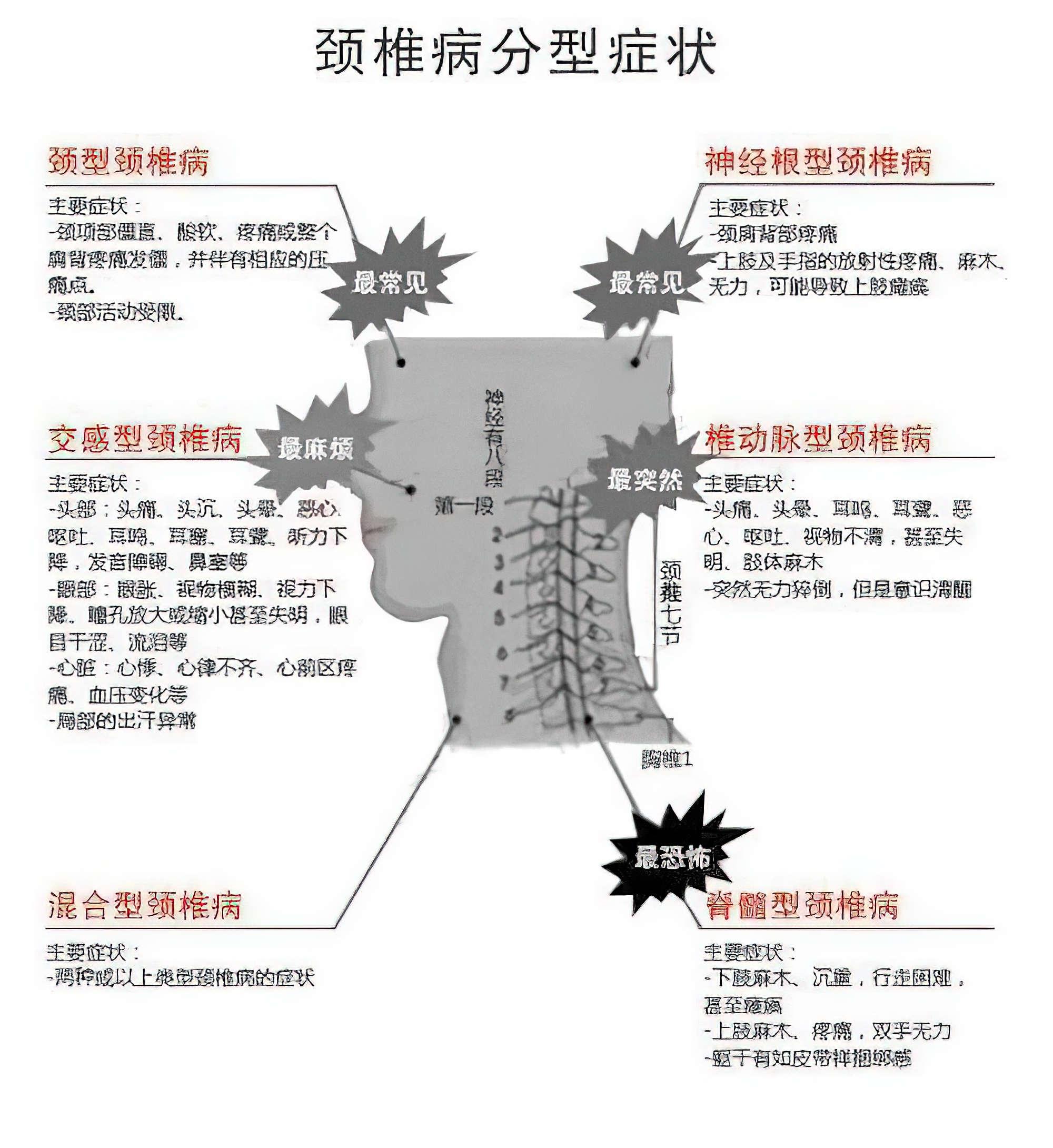 交感型颈椎病有何特点?