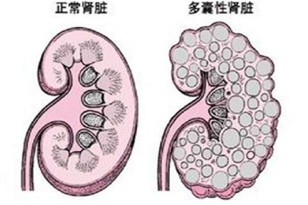 體檢發現腎囊腫,身體會出現什麼症狀? - 盾靈網